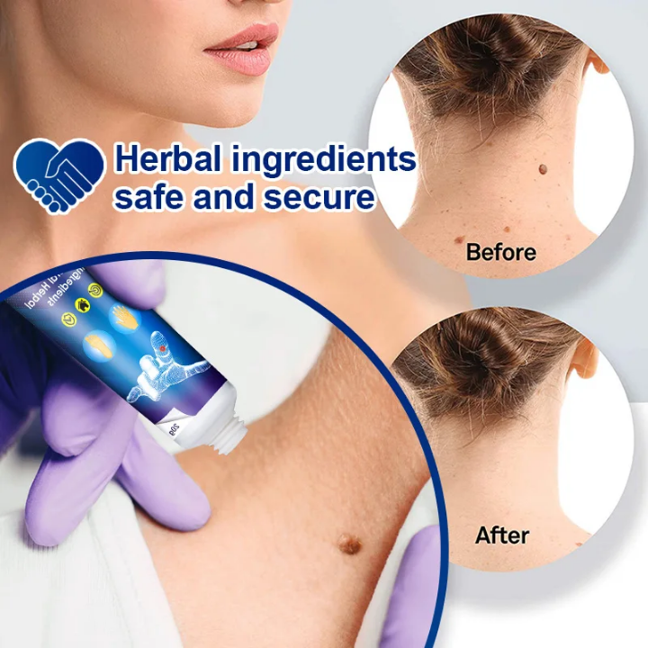 Sumifun Wart Remover Ointment